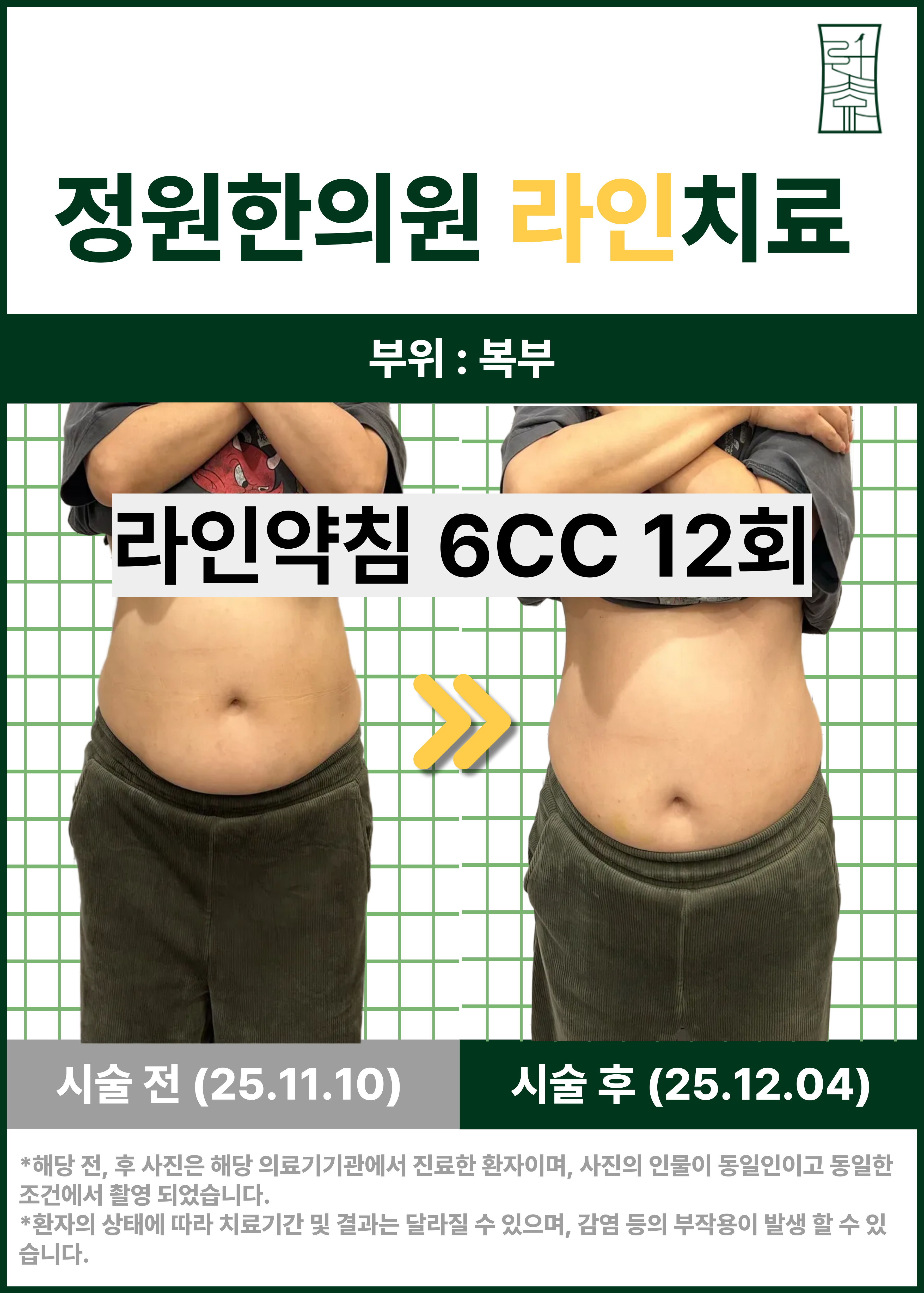복부 라인 약침 관리 사례  치료 전