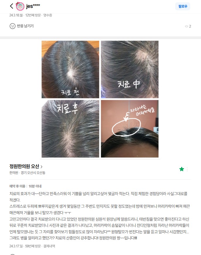 원형탈모 치료 후기 - 언제 탈모였냐는 듯 자리를 찾아보기 힘들 정도로 많이 자라났습니다! 치료 전