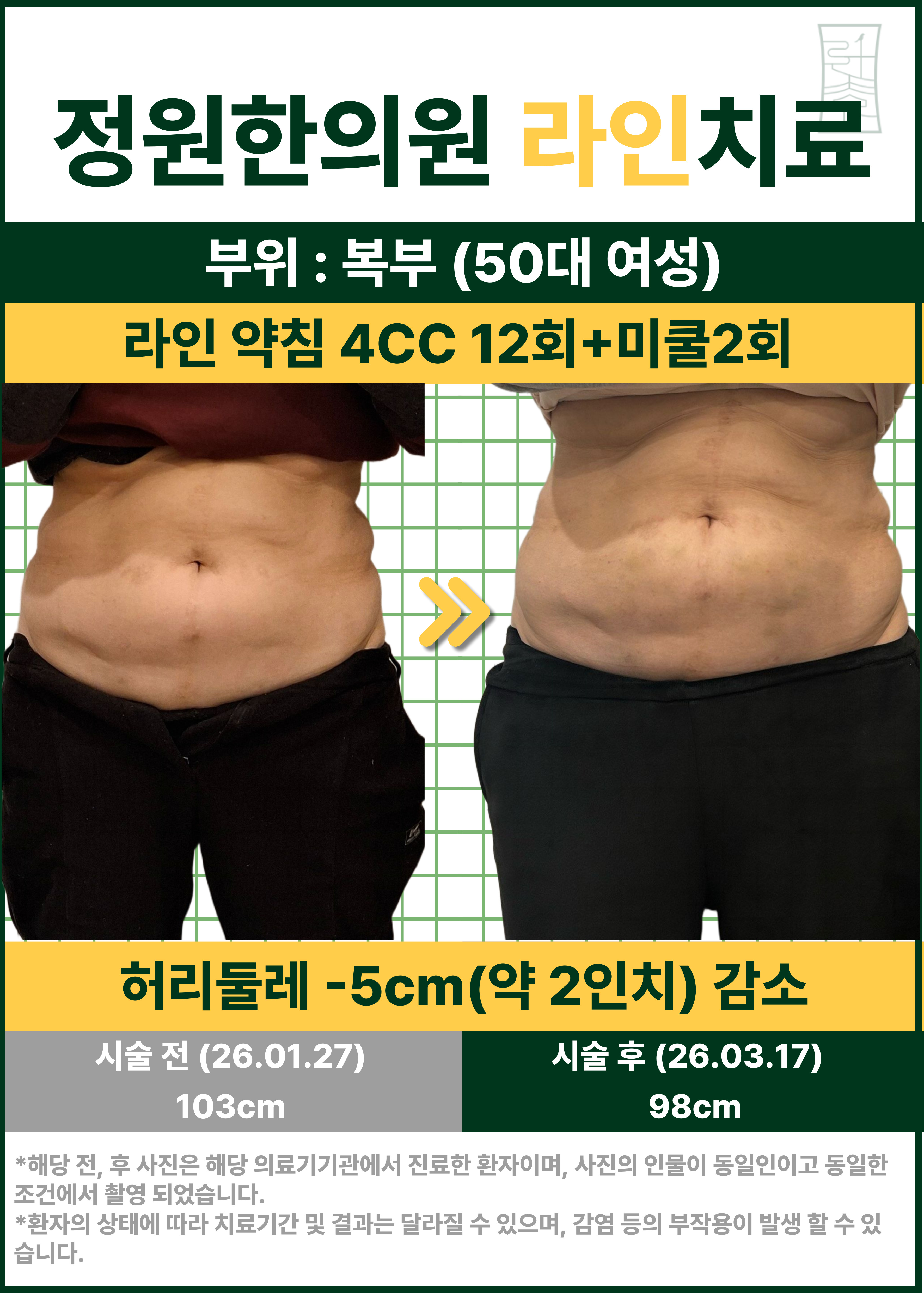 약침과 미쿨을 병행한 복부 라인 관리 경과 사례 (50대 여성) 치료 전