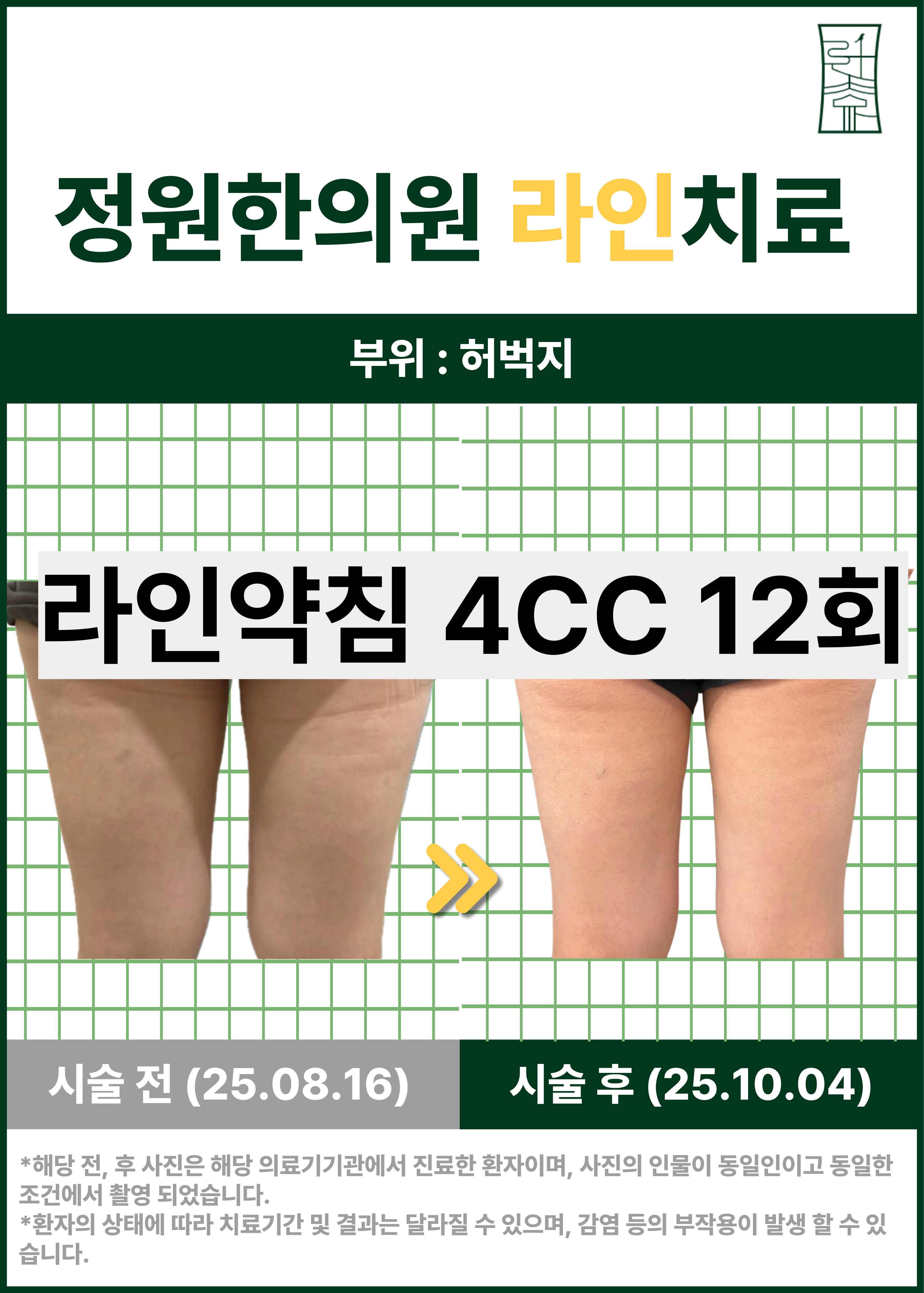 치료 전