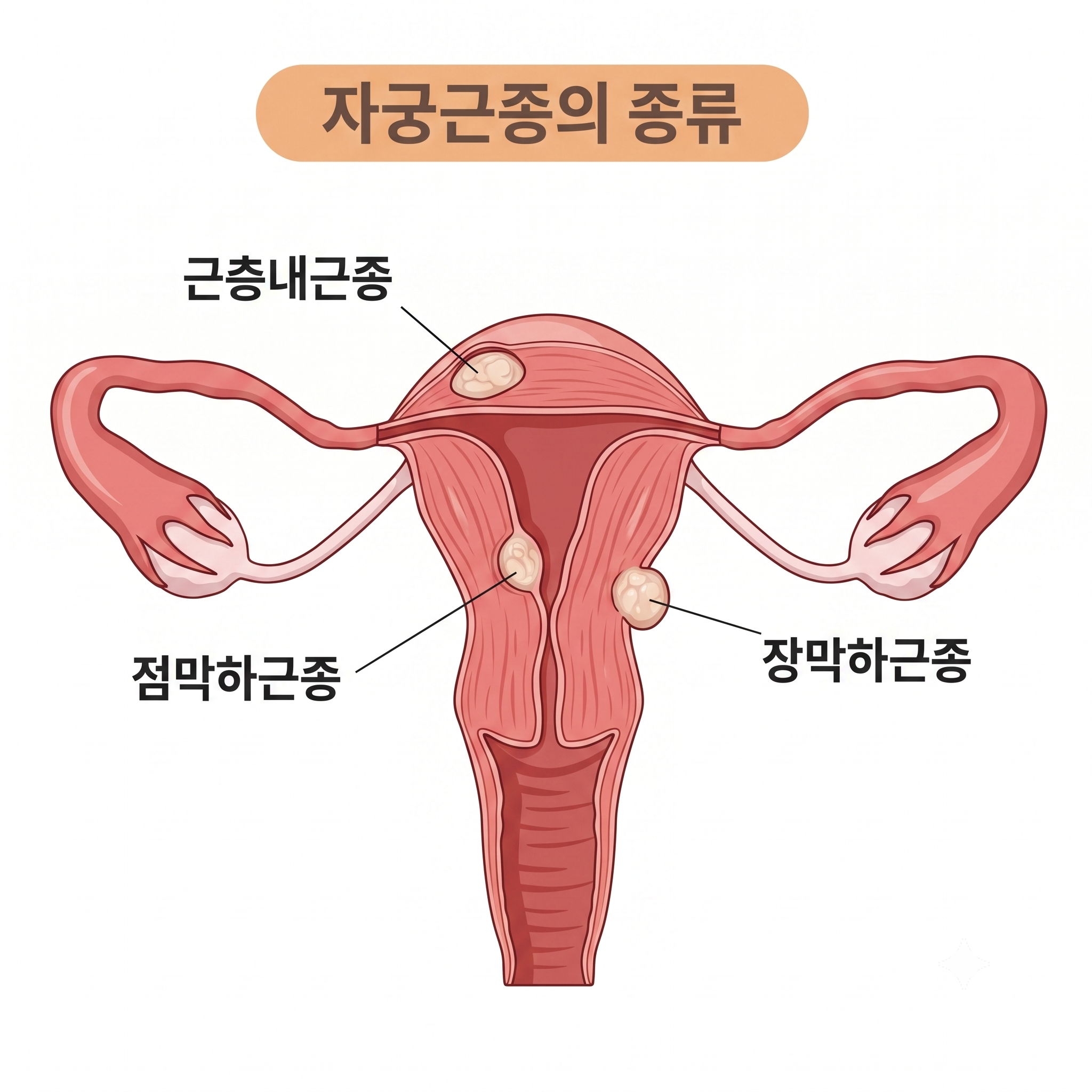 한약 먹으면 자궁근종이 커지거나 암이 생긴다던데, 사실인가요?